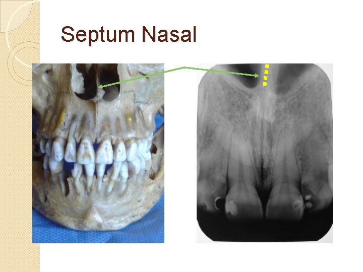 Septum Nasal 
