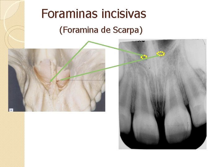 Foraminas incisivas (Foramina de Scarpa) 