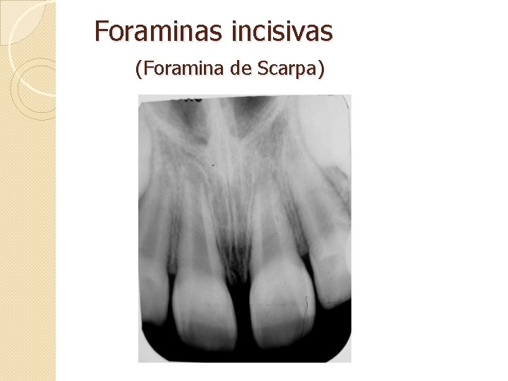Foraminas incisivas (Foramina de Scarpa) 