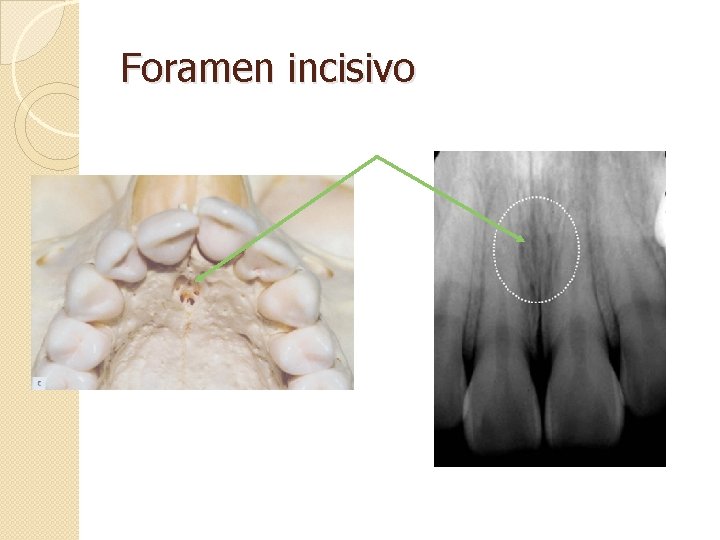 Foramen incisivo 