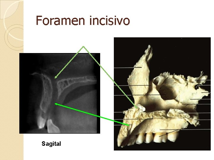 Foramen incisivo Sagital 