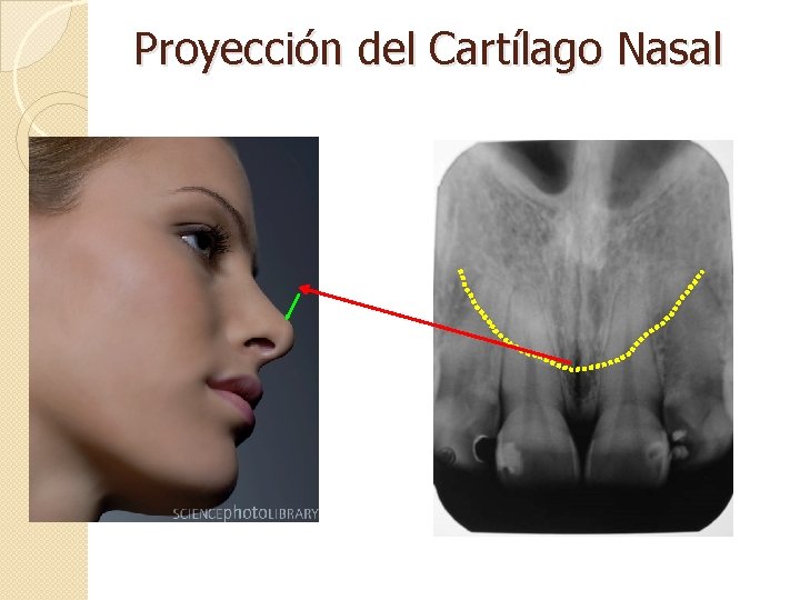 Proyección del Cartílago Nasal 