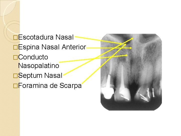 �Escotadura Nasal �Espina Nasal Anterior �Conducto Nasopalatino �Septum Nasal �Foramina de Scarpa 