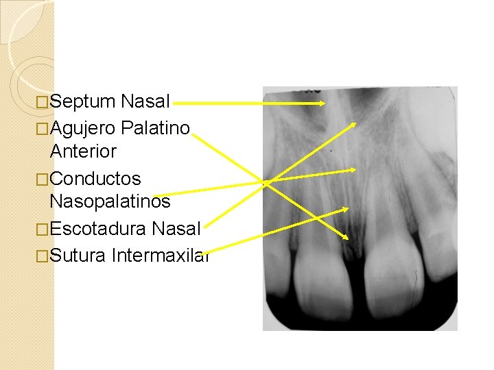 �Septum Nasal �Agujero Palatino Anterior �Conductos Nasopalatinos �Escotadura Nasal �Sutura Intermaxilar 