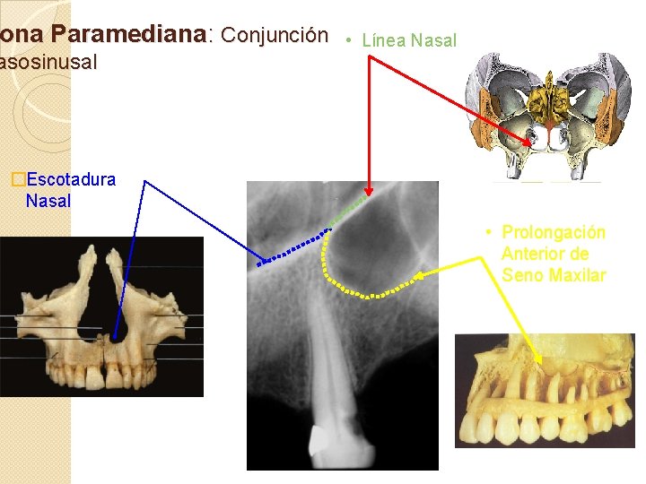 ona Paramediana: Conjunción asosinusal • Línea Nasal �Escotadura Nasal • Prolongación Anterior de Seno