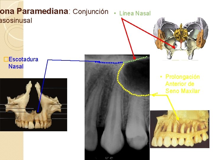 ona Paramediana: Conjunción asosinusal • Línea Nasal �Escotadura Nasal • Prolongación Anterior de Seno