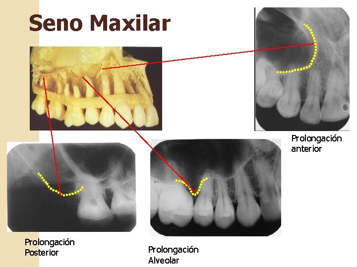 Seno Maxilar Prolongación anterior Prolongación Posterior Prolongación Alveolar 