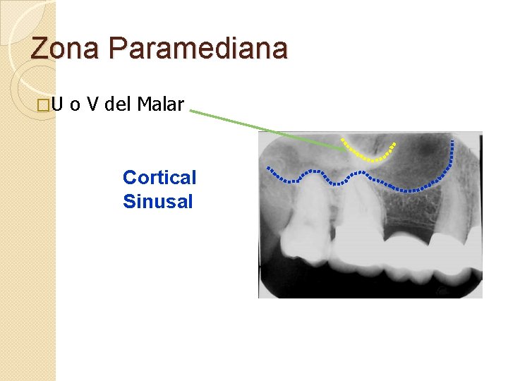 Zona Paramediana �U o V del Malar Cortical Sinusal 