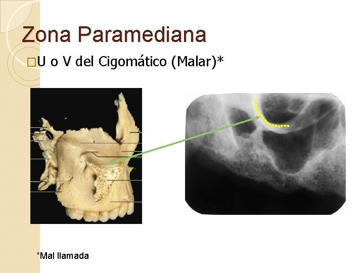 Zona Paramediana �U o V del Cigomático (Malar)* *Mal llamada 