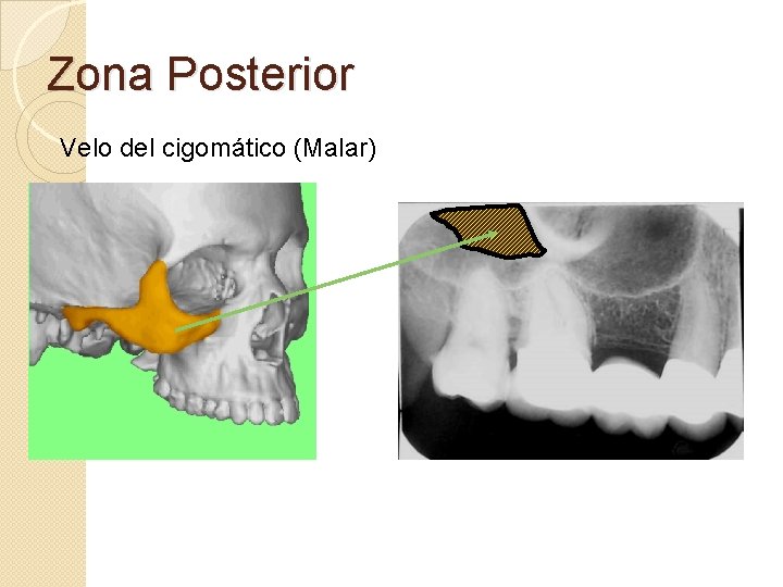 Zona Posterior Velo del cigomático (Malar) 