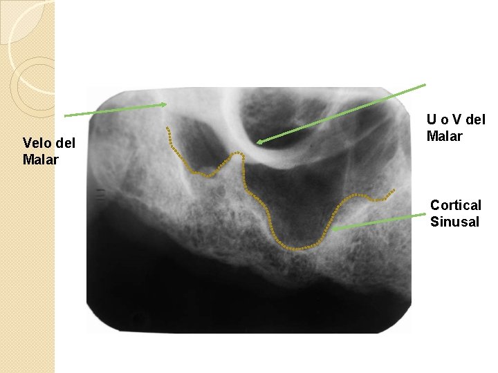 Velo del Malar U o V del Malar Cortical Sinusal 