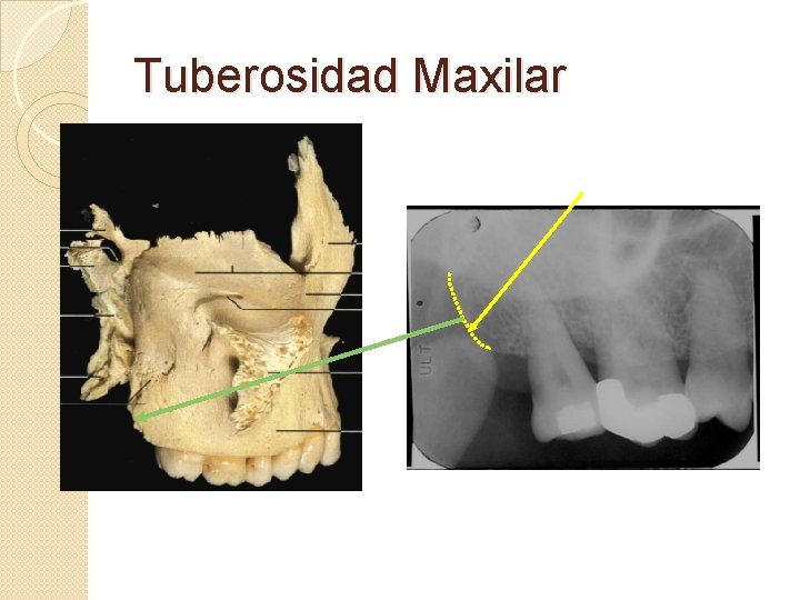 Tuberosidad Maxilar 