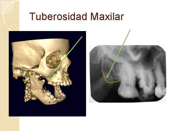 Tuberosidad Maxilar 