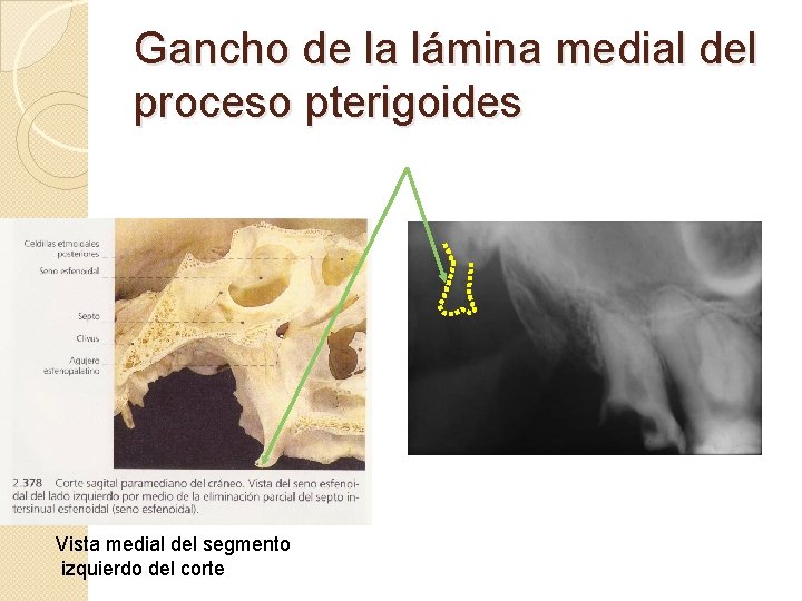 Gancho de la lámina medial del proceso pterigoides Vista medial del segmento izquierdo del