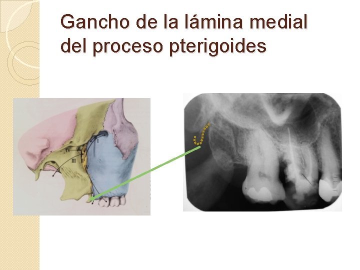 Gancho de la lámina medial del proceso pterigoides 