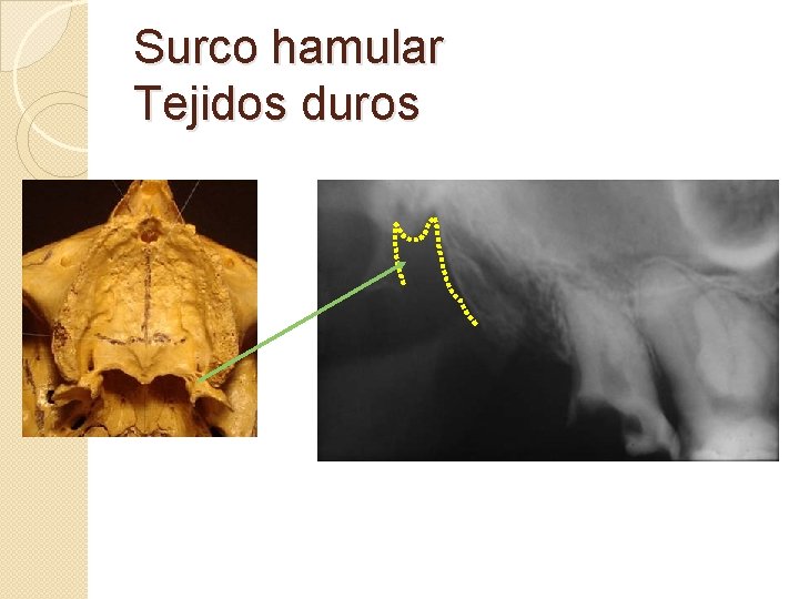 Surco hamular Tejidos duros 