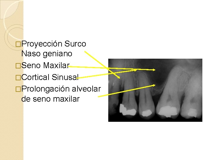 �Proyección Surco Naso geniano �Seno Maxilar �Cortical Sinusal �Prolongación alveolar de seno maxilar 