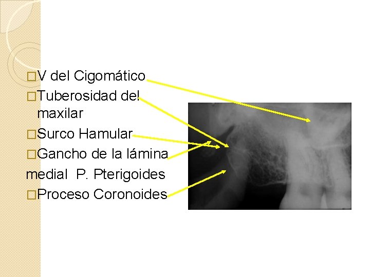 �V del Cigomático �Tuberosidad del maxilar �Surco Hamular �Gancho de la lámina medial P.
