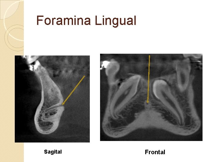 Foramina Lingual Sagital Frontal 