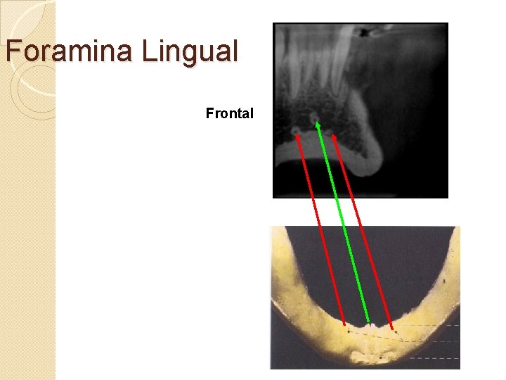 Foramina Lingual Frontal 