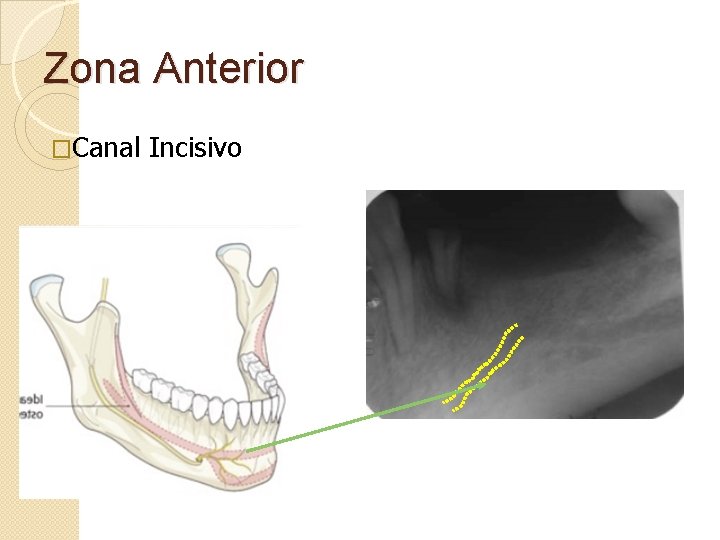 Zona Anterior �Canal Incisivo 