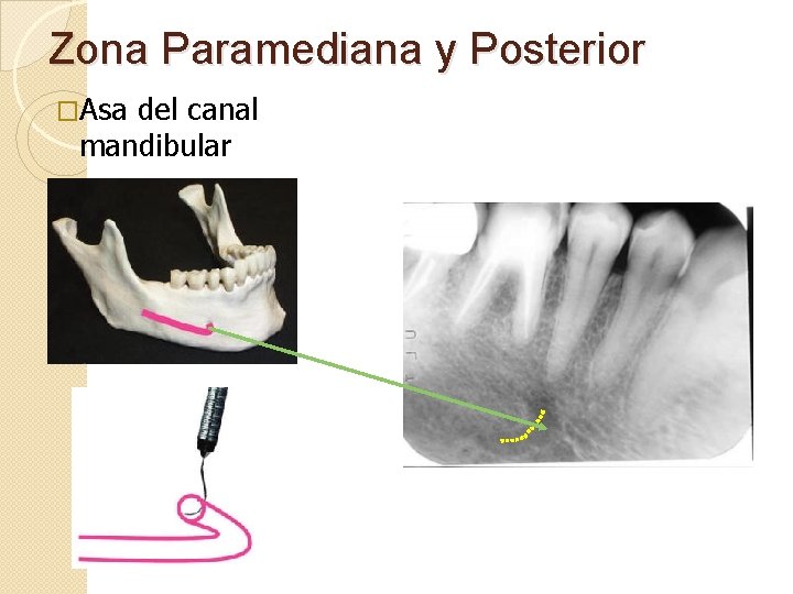 Zona Paramediana y Posterior �Asa del canal mandibular 