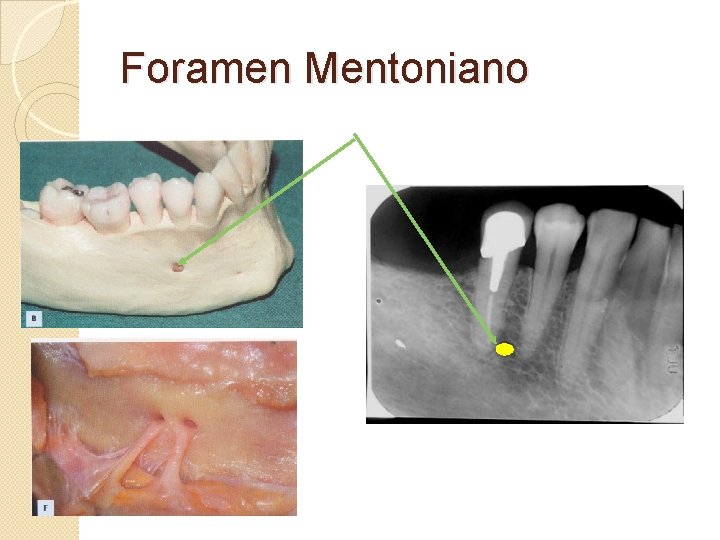 Foramen Mentoniano 