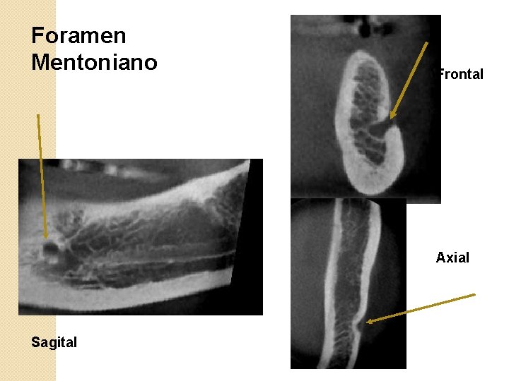 Foramen Mentoniano Frontal Axial Sagital 