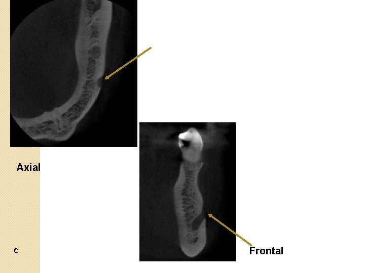 Axial c Frontal 