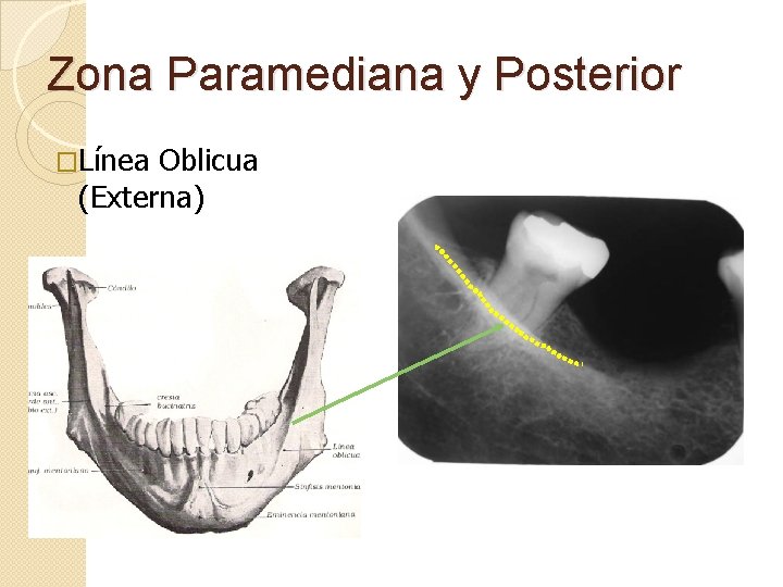 Zona Paramediana y Posterior �Línea Oblicua (Externa) 