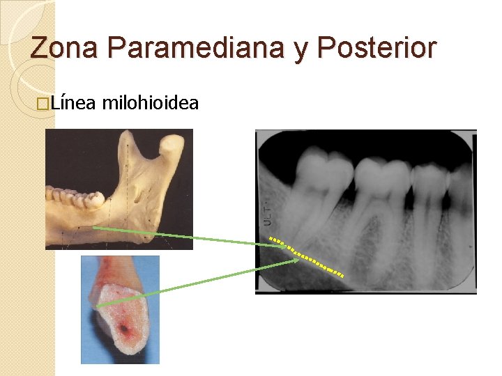 Zona Paramediana y Posterior �Línea milohioidea 