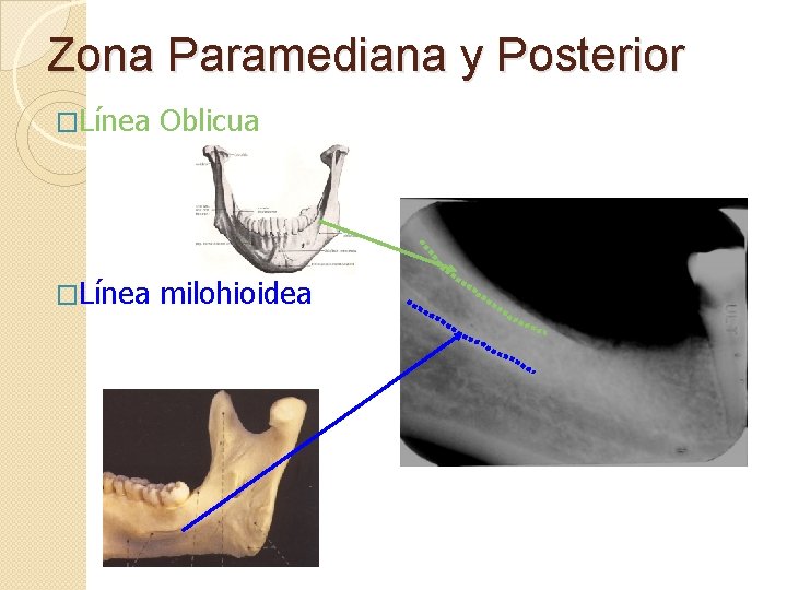 Zona Paramediana y Posterior �Línea Oblicua �Línea milohioidea 