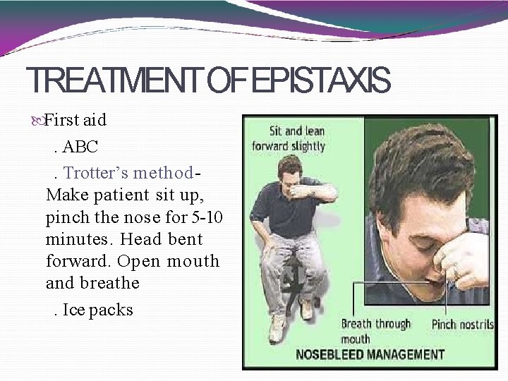 TREATMENTOFEPISTAXIS First aid . ABC. Trotter’s method. Make patient sit up, pinch the nose
