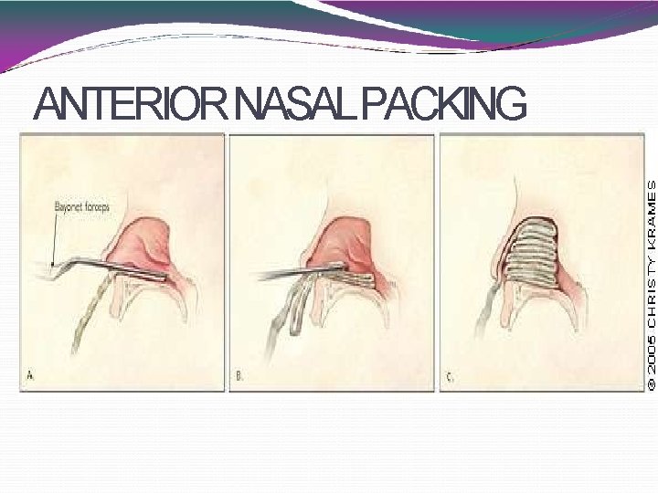 ANTERIOR NASALPACKING 