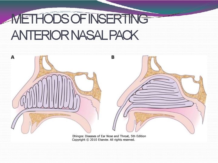 METHODS OFINSERTING ANTERIOR NASALPACK 