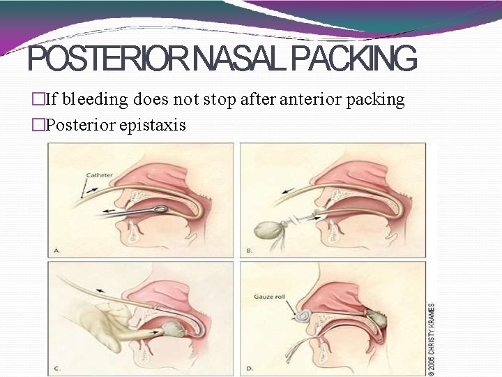 POSTERIORNASAL PACKING �If bleeding does not stop after anterior packing �Posterior epistaxis 