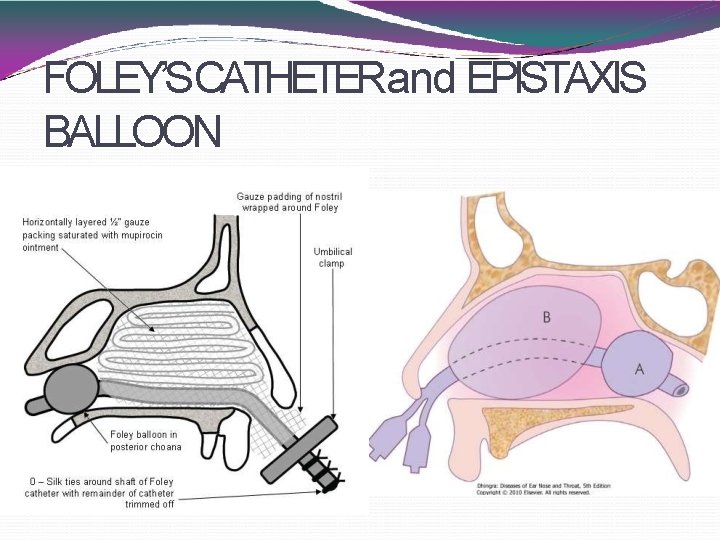 FOLEY’SCATHETERand EPISTAXIS BALLOON 