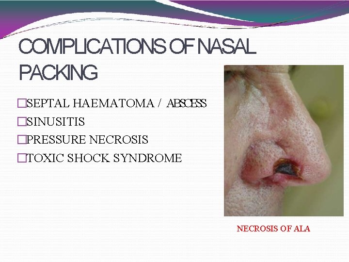 COMPLICATIONS OFNASAL PACKING �SEPTAL HAEMATOMA / ABSCESS �SINUSITIS �PRESSURE NECROSIS �TOXIC SHOCK SYNDROME NECROSIS