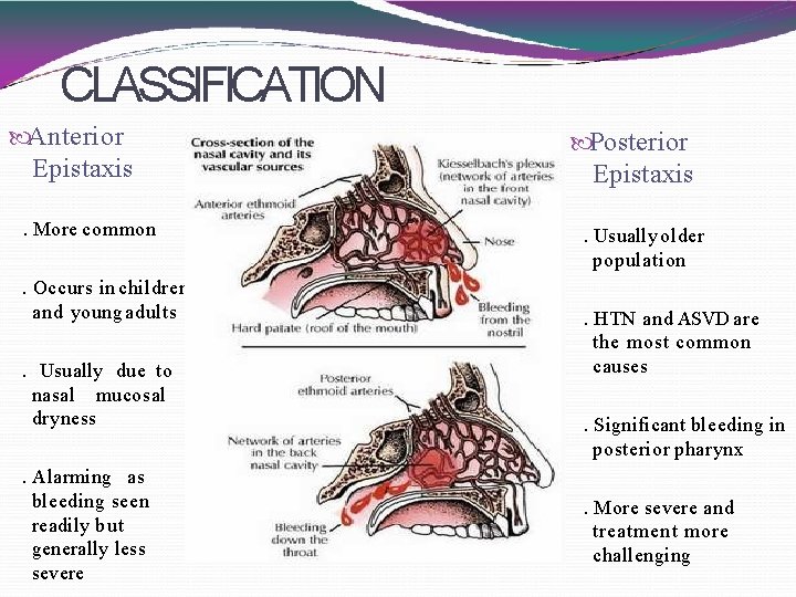 CLASSIFICATION Anterior Epistaxis. More common. Occurs in children and young adults. Usually due to