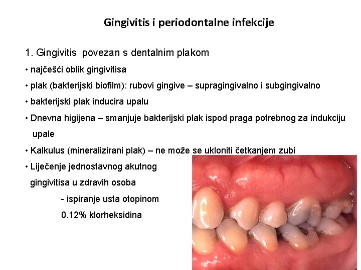 Gingivitis i periodontalne infekcije 1. Gingivitis povezan s dentalnim plakom • najčešći oblik gingivitisa