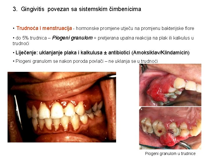 3. Gingivitis povezan sa sistemskim čimbenicima • Trudnoća i menstruacija - hormonske promjene utječu