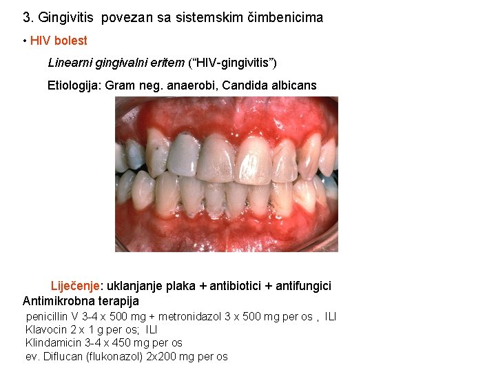 3. Gingivitis povezan sa sistemskim čimbenicima • HIV bolest Linearni gingivalni eritem (“HIV-gingivitis”) Etiologija: