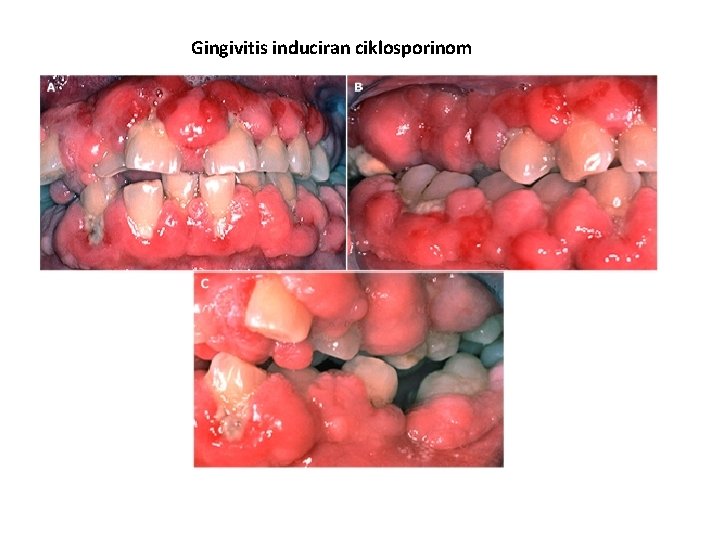 Gingivitis induciran ciklosporinom 