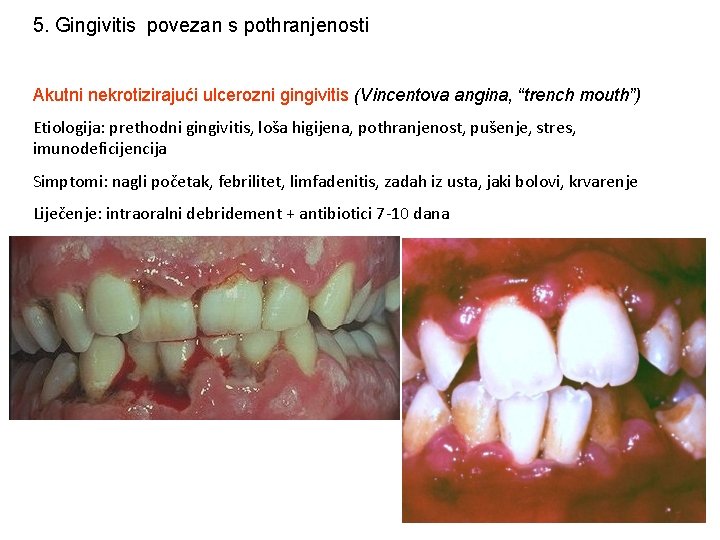 5. Gingivitis povezan s pothranjenosti Akutni nekrotizirajući ulcerozni gingivitis (Vincentova angina, “trench mouth”) Etiologija: