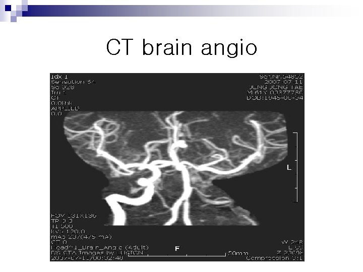 CT brain angio 