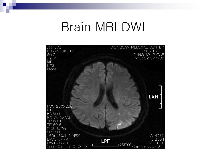 Brain MRI DWI 