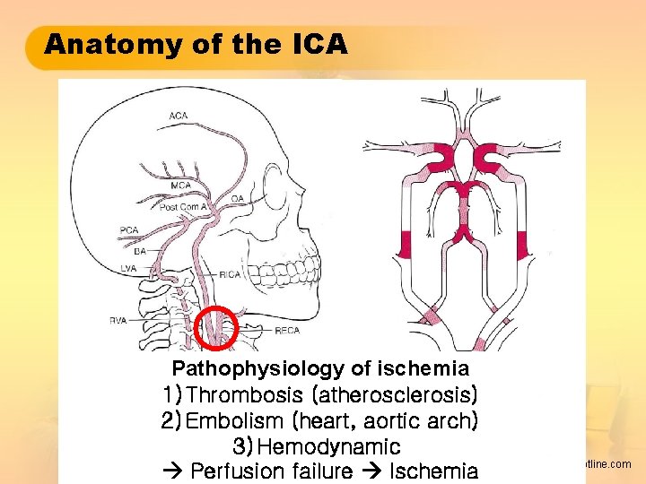 Anatomy of the ICA Pathophysiology of ischemia 1) Thrombosis (atherosclerosis) 2) Embolism (heart, aortic
