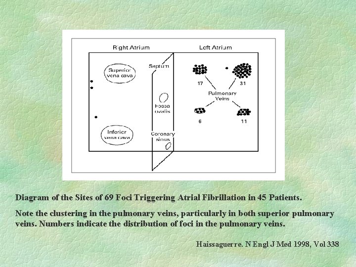 Diagram of the Sites of 69 Foci Triggering Atrial Fibrillation in 45 Patients. Note