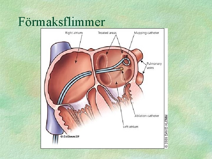 Förmaksflimmer 