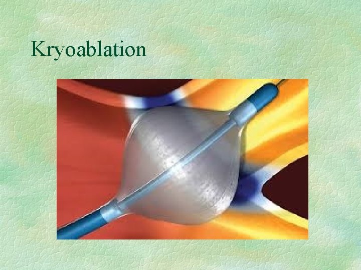 Kryoablation 